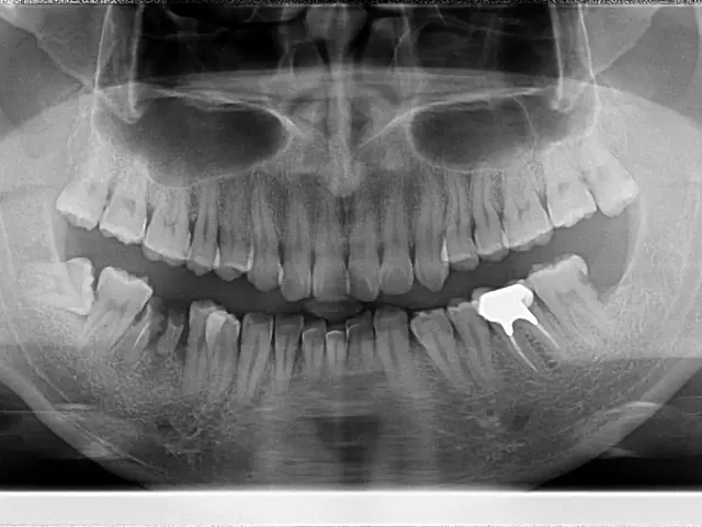 Dental RVG Intraoral X-Ray Sensor Sourcing from Shanghai: CMOS Digital Sensor Guide
