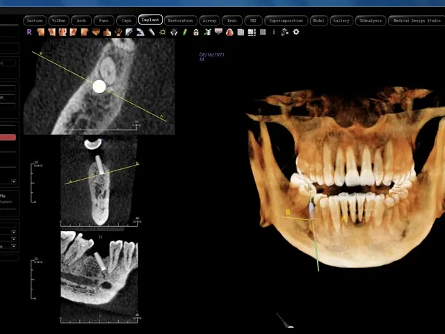 Anatomage implant planning