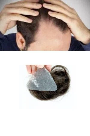Thin skin hair patch for balding temples shown from above with the front hairline visible