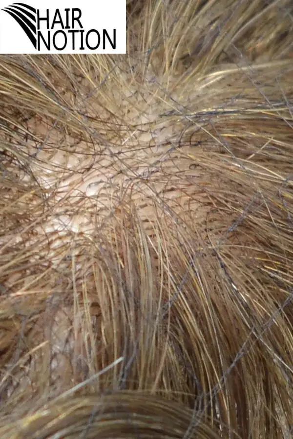 STS-IT super thin skin men's hair system shown from above with the front hairline visible
