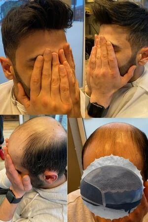 Lace front silk top toupee for men shown from above with the front hairline visible