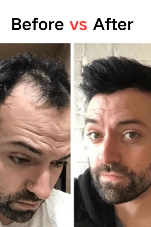 Before and after image of a man wearing a thin skin toupee, showing natural hairline integration