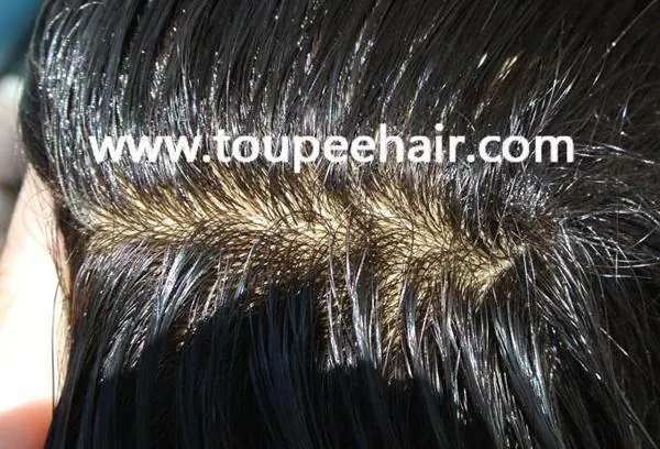 injected hair root